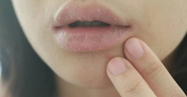 Bibir Kering dan Pecah-Pecah? Atasi Dengan Tips Ini
